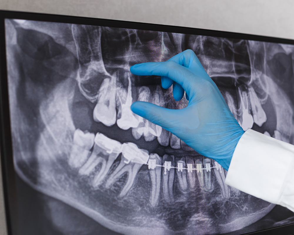 Root Canal Therapy